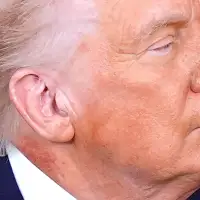 White House attributes redness on Trump's neck to skin cream but doesn't say what it's treating